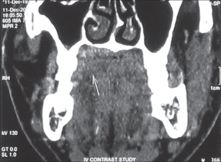 45-year-old male patient with lesion over on the right side of the palate diagnosed as mucoepidermoid carcinoma – intermediate stage. Coronal CT image shows the lesion as a faint soft tissue mass (arrow) on the palate.